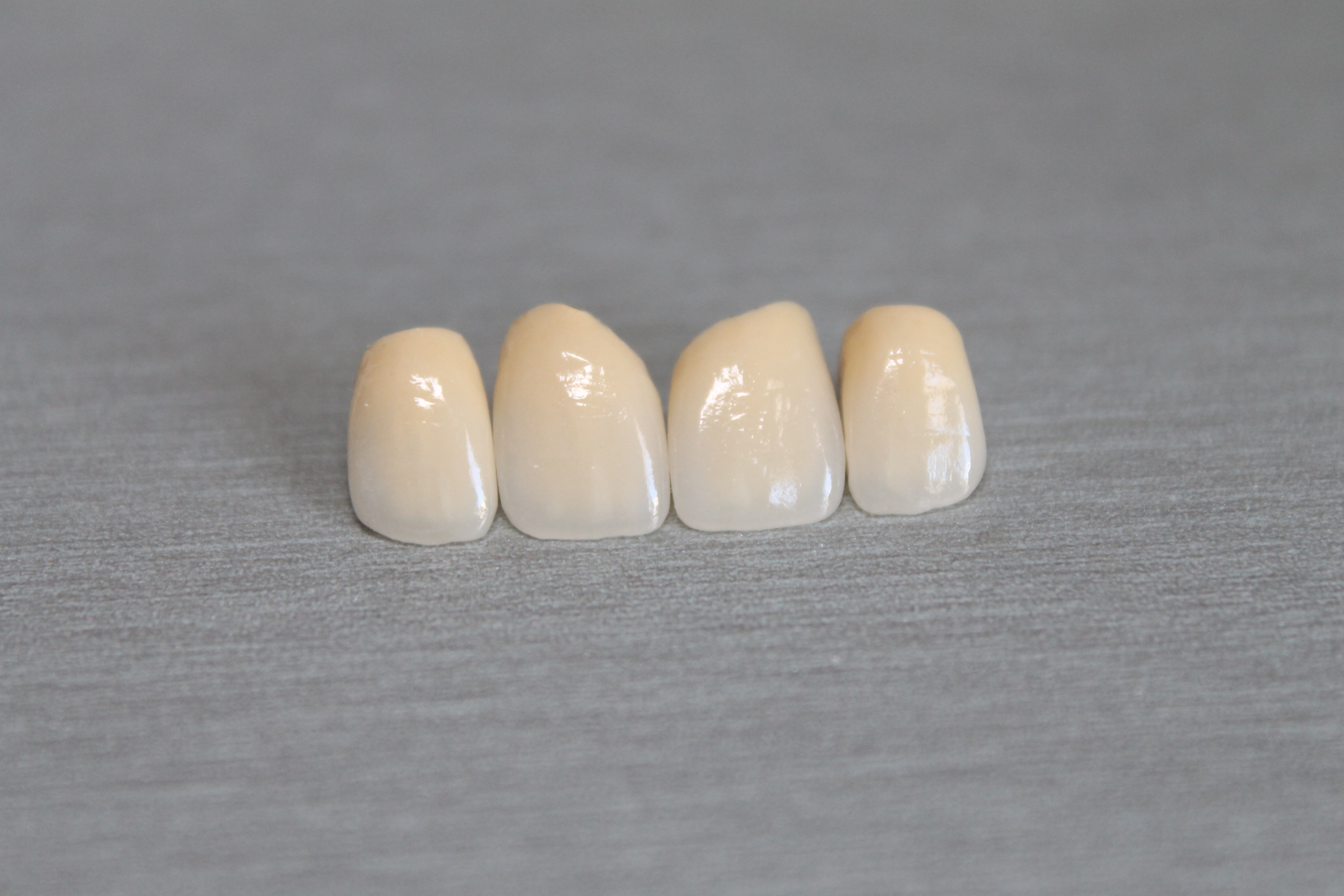 Циркониева конструкция на горни резци (12–22) — снимка 2