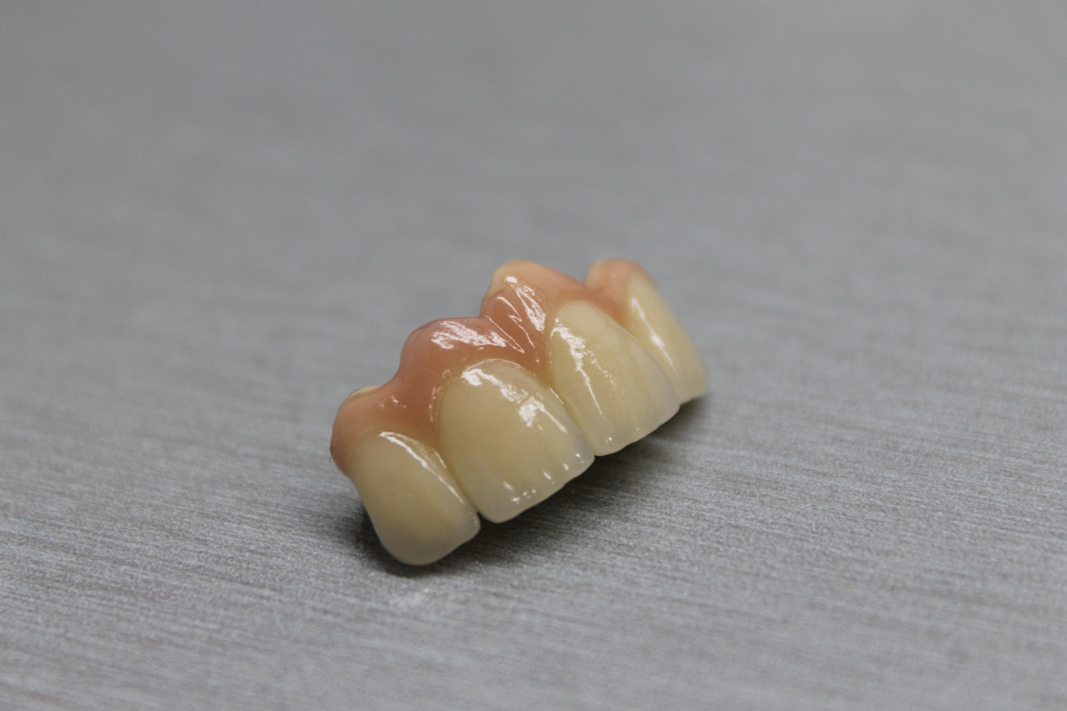 Послойна керамика на горни резци (12–22) — снимка 1