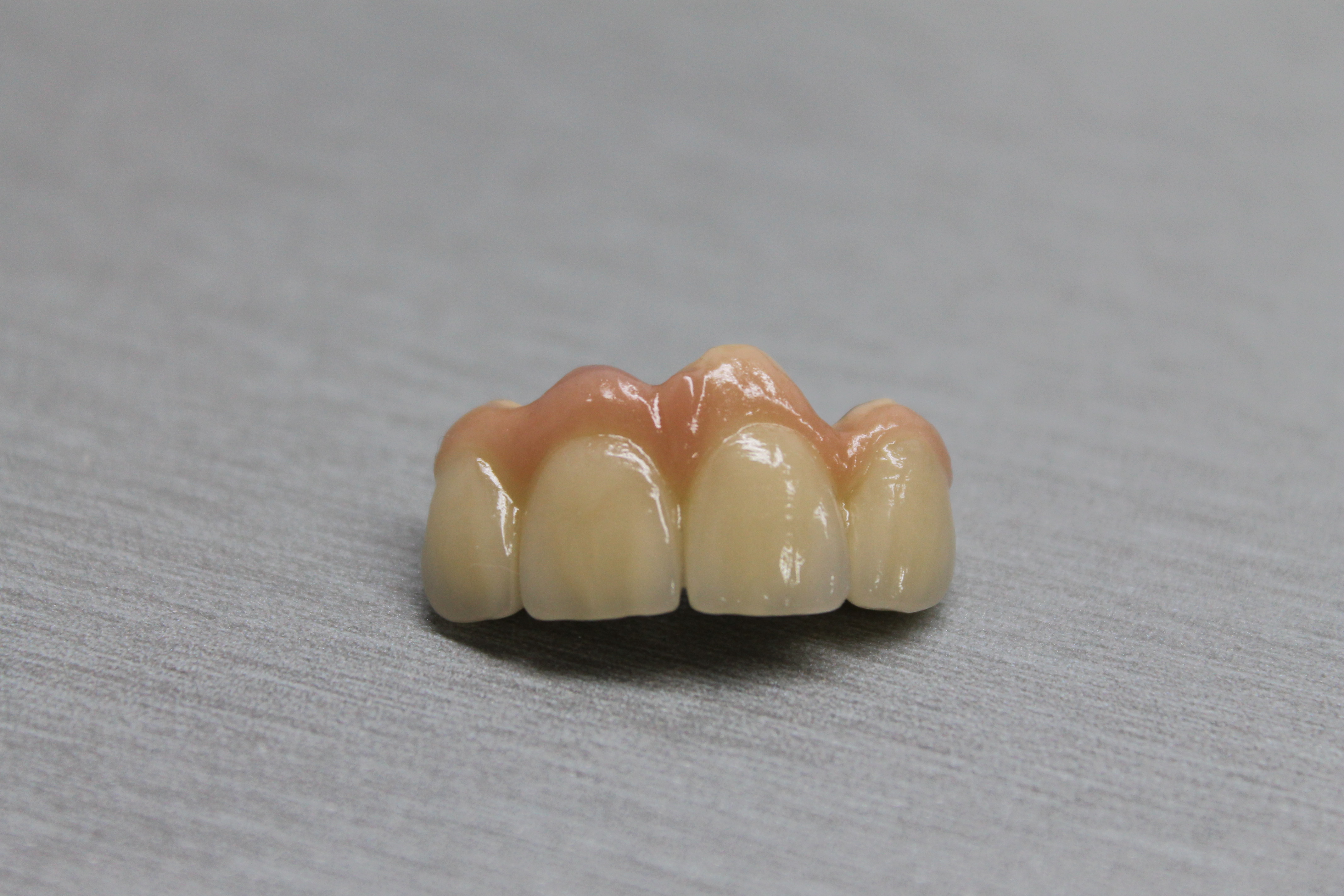 Послойна керамика на горни резци (12–22) — снимка 2